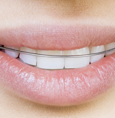 Retainers